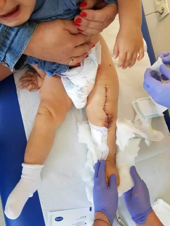 lena po 1 operacji 2.jpg